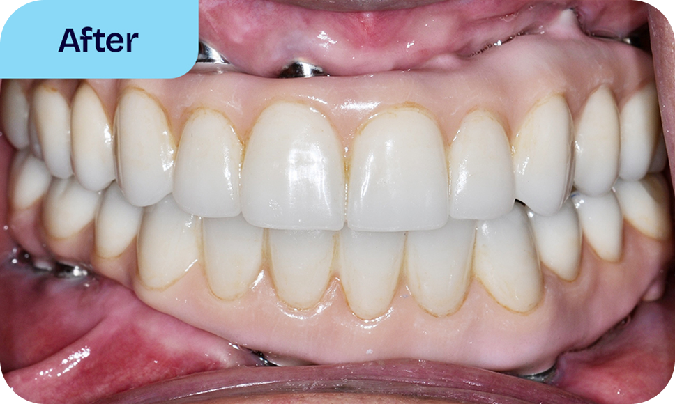 Benefits of All-On-4 implant bridges - after