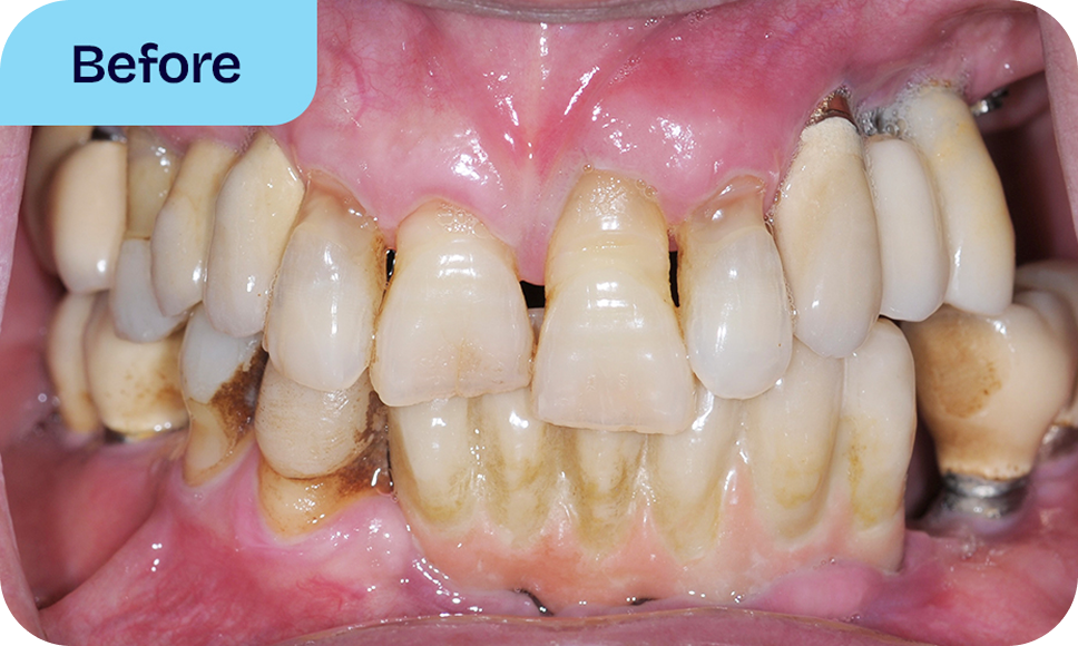 Benefits of All-On-4 implant bridges - before