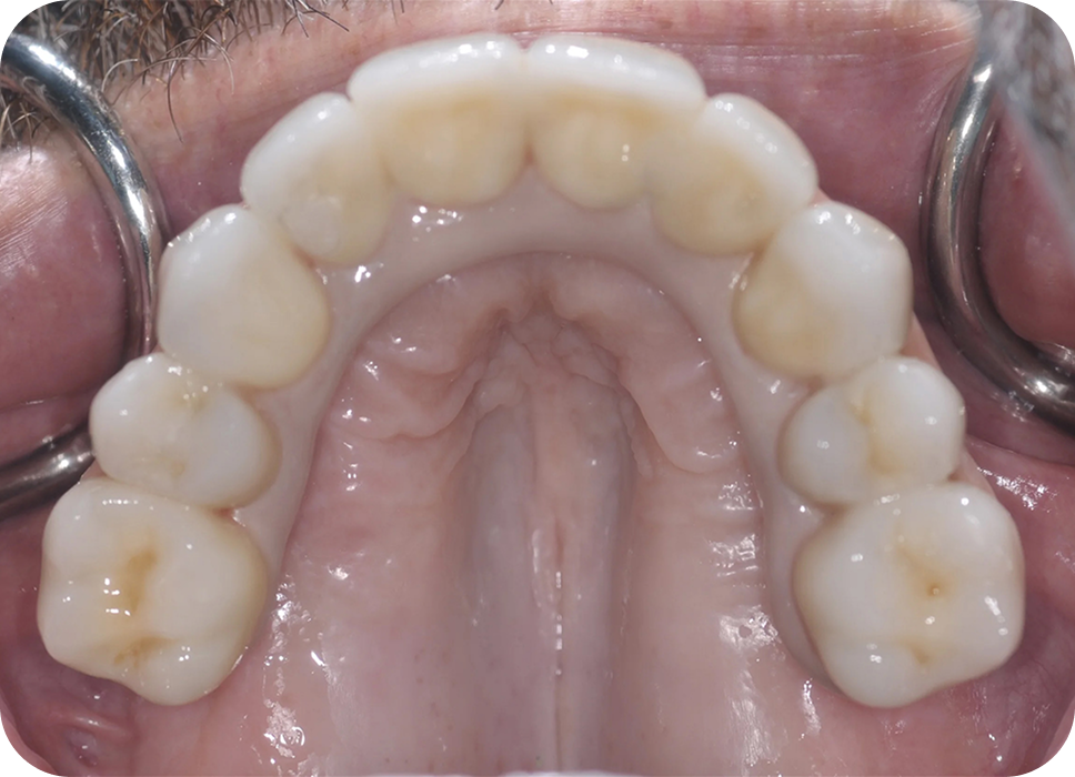 Are you a good candidate for All-On-4 implant bridges - after