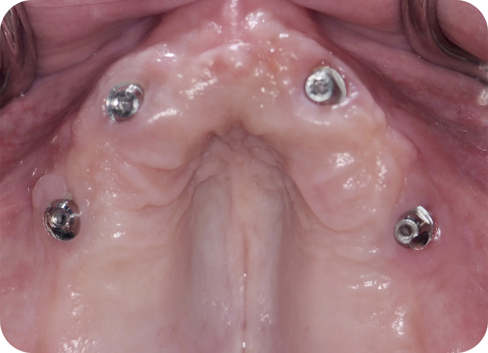 Are you a good candidate for All-On-4 implant bridges - before