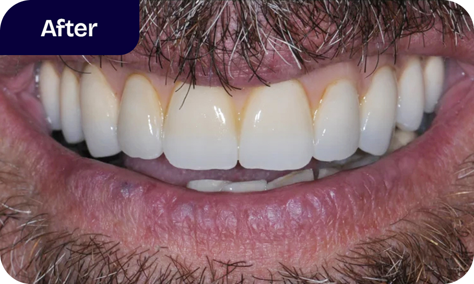 Our All-On-4 dentures bridge treatment process - after