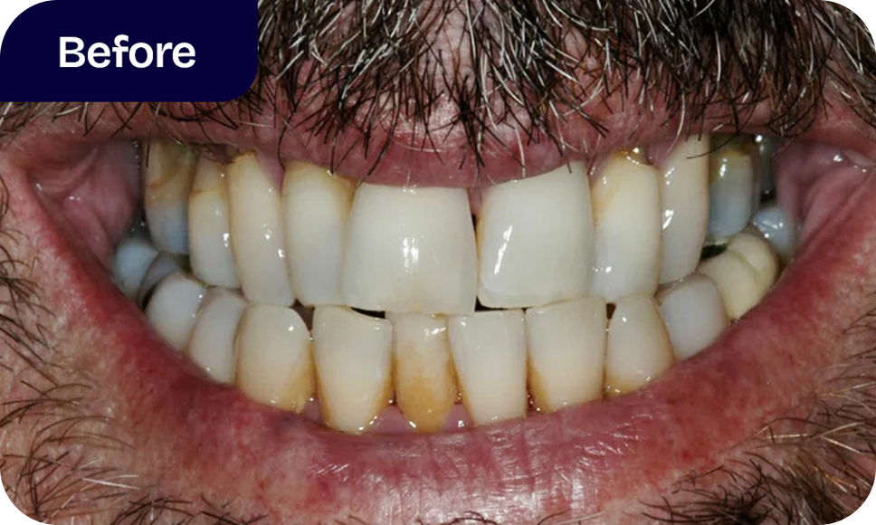 Our All-On-4 dentures bridge treatment process - before