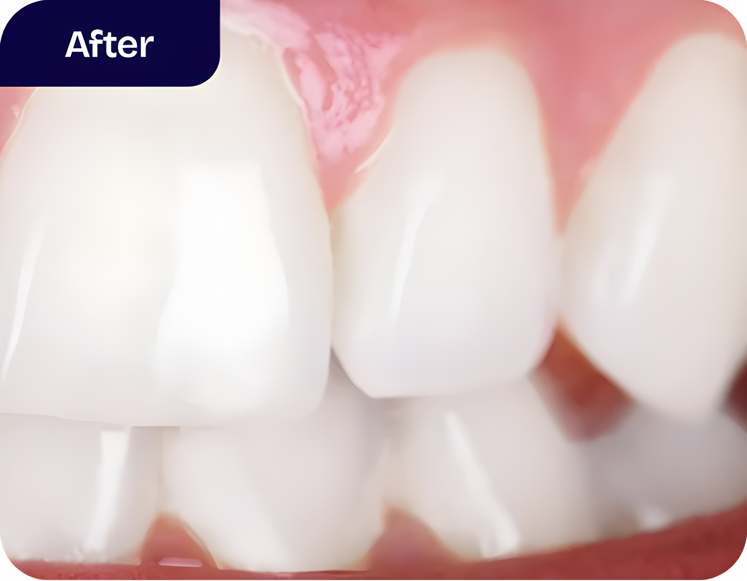 At-home teeth whitening treatment process - after