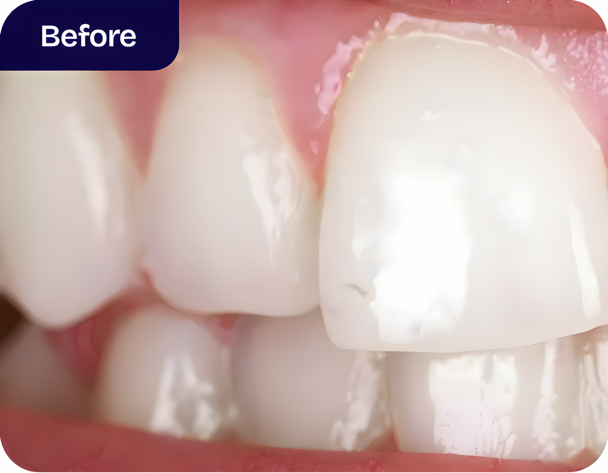 At-home teeth whitening treatment process - before