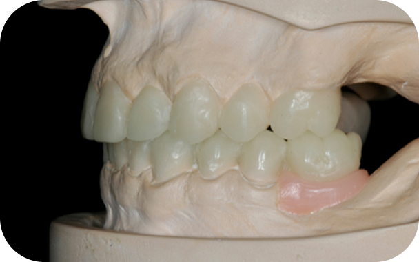 Treatment and Restoration