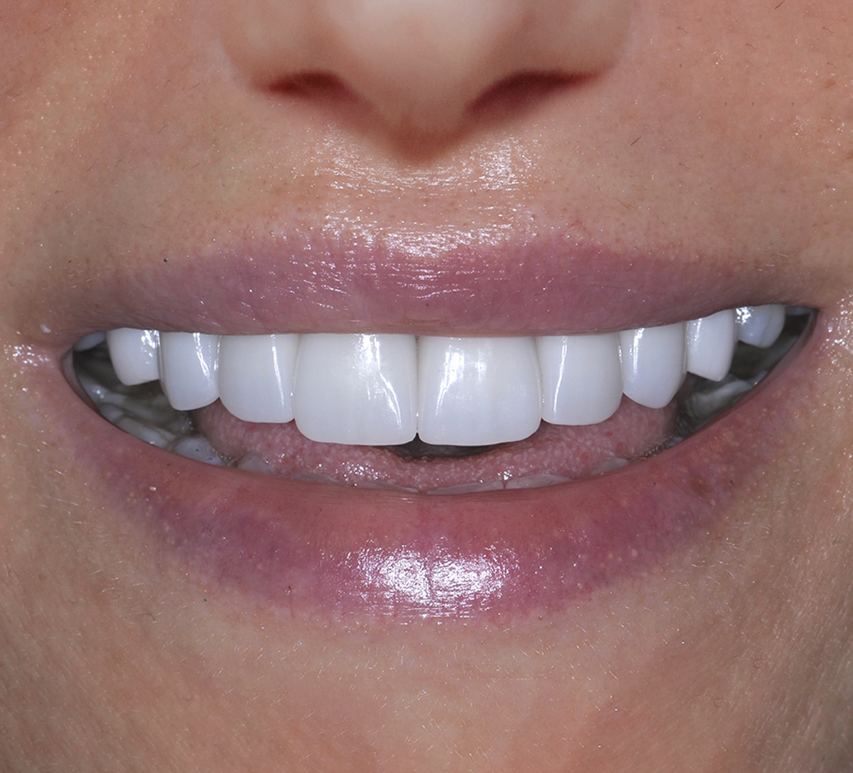 Porcelain Veneers