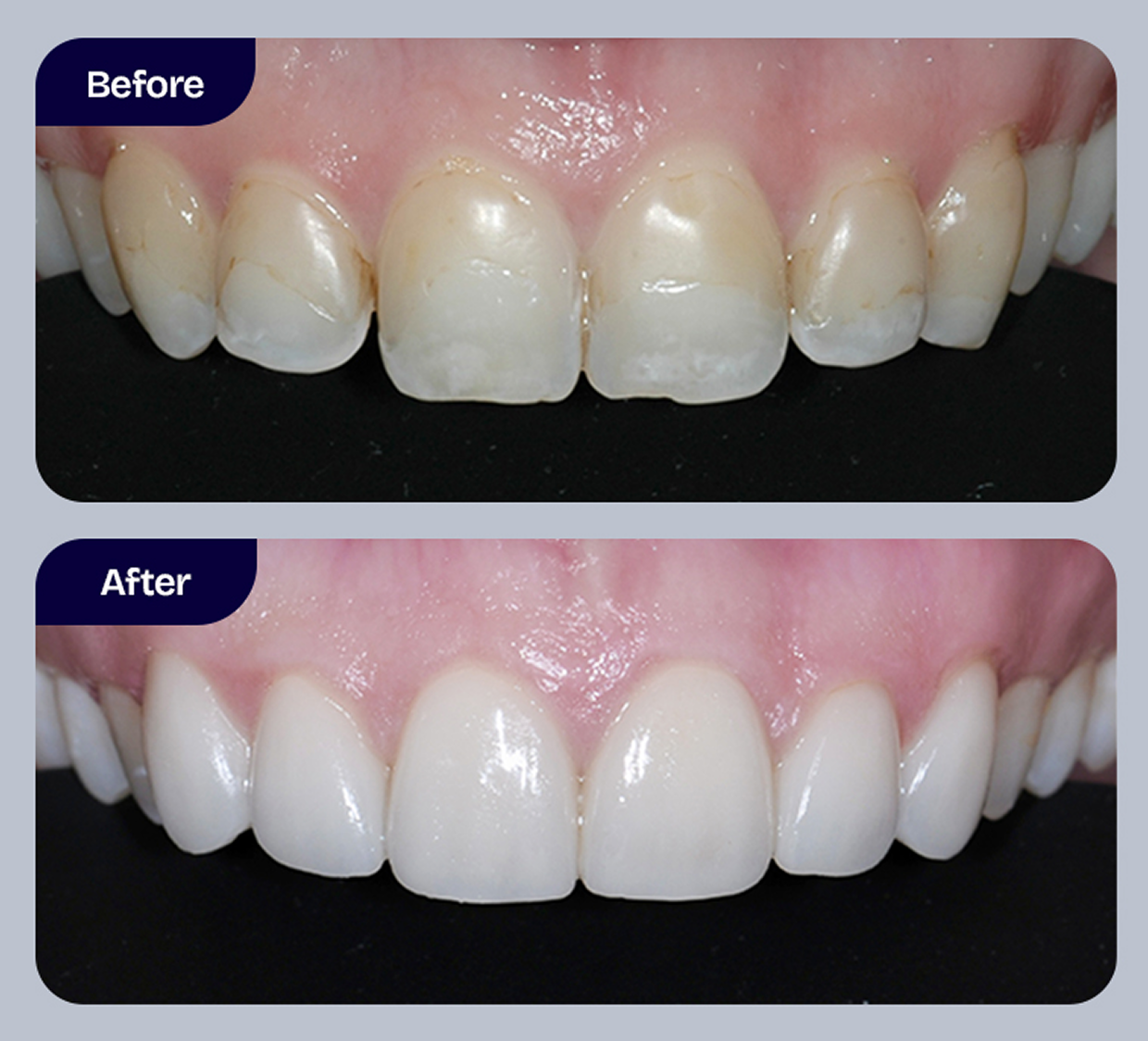 Smile Makeover