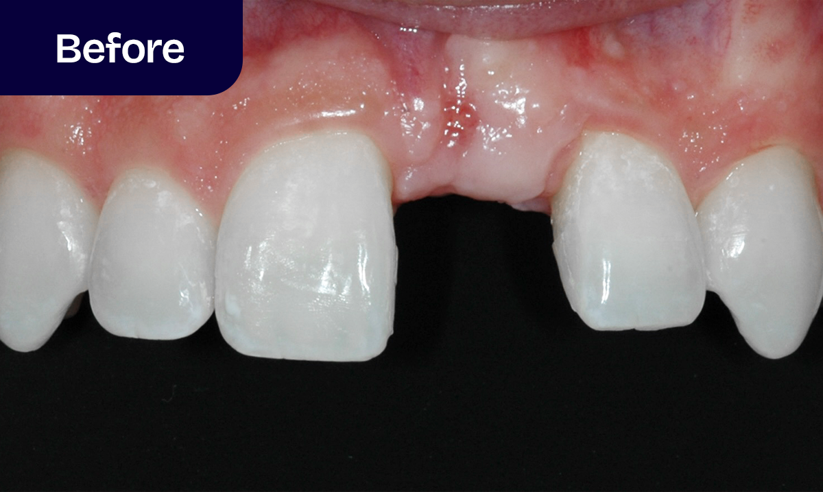 Our Dental Bridges Process - Dr. Adam Geach Dental Practitioner