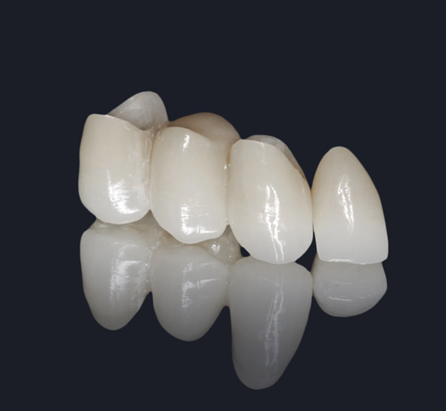 Custom dental bridge restoration at Geach Dental
