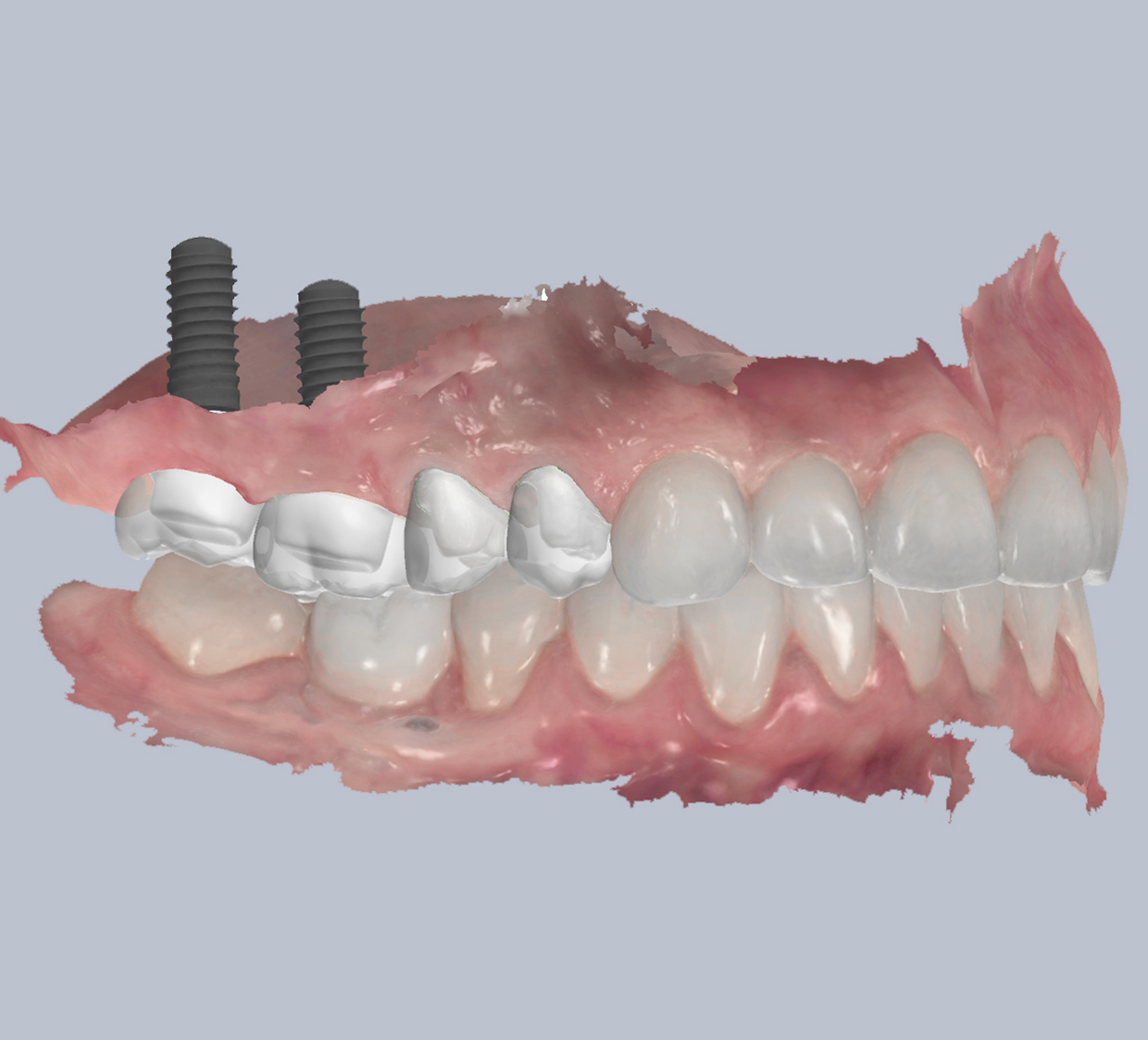Dr. Adam Geach Dental Practitioner Specialized in Prosthodontics Dental Crowns