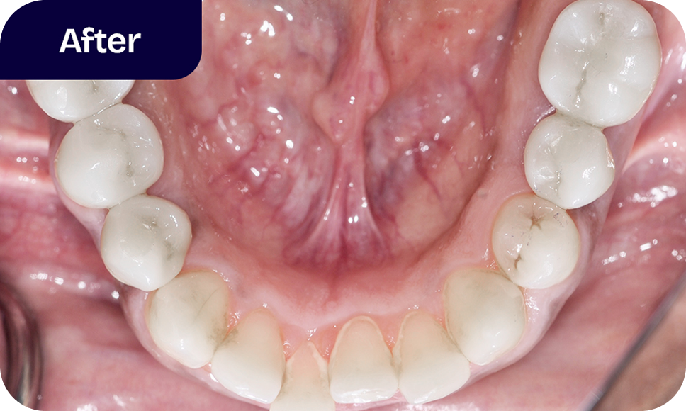 After dental implants
