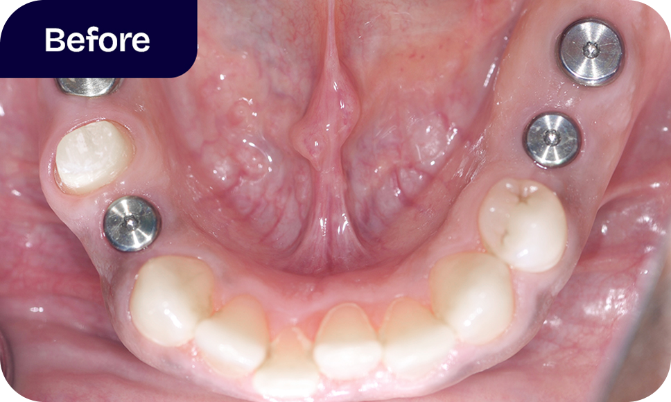 Before dental implants