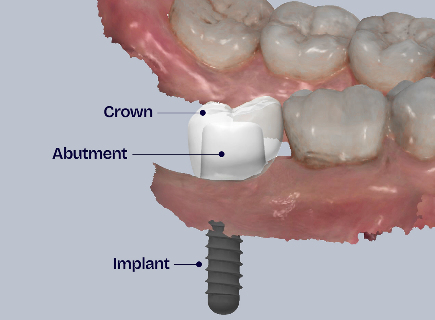 Dr. Adam Geach Dental Practitioner Specialized in Prosthodontics Dental Implants Further Explained