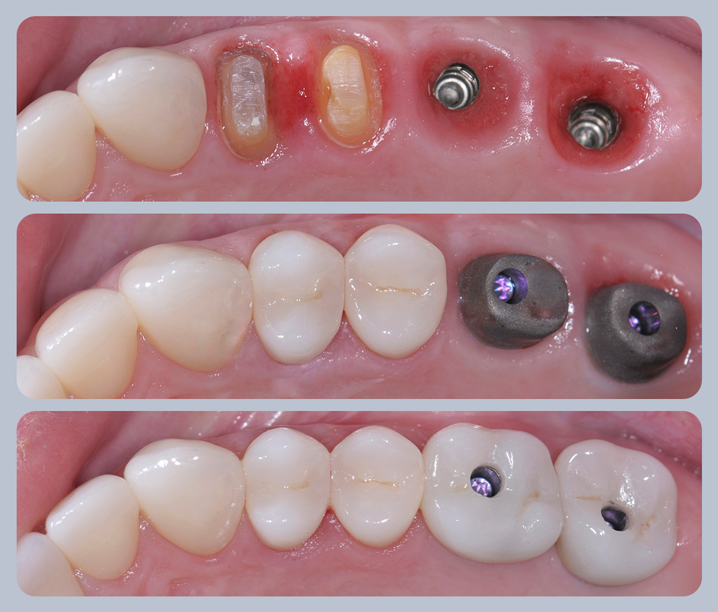 More about dental implants further explained