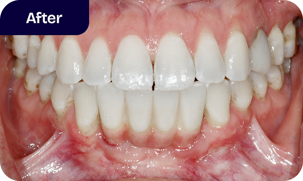 Our dental implant process - after