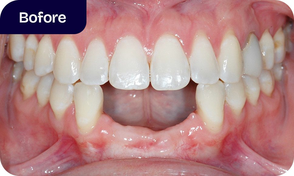 Our dental implant process - before