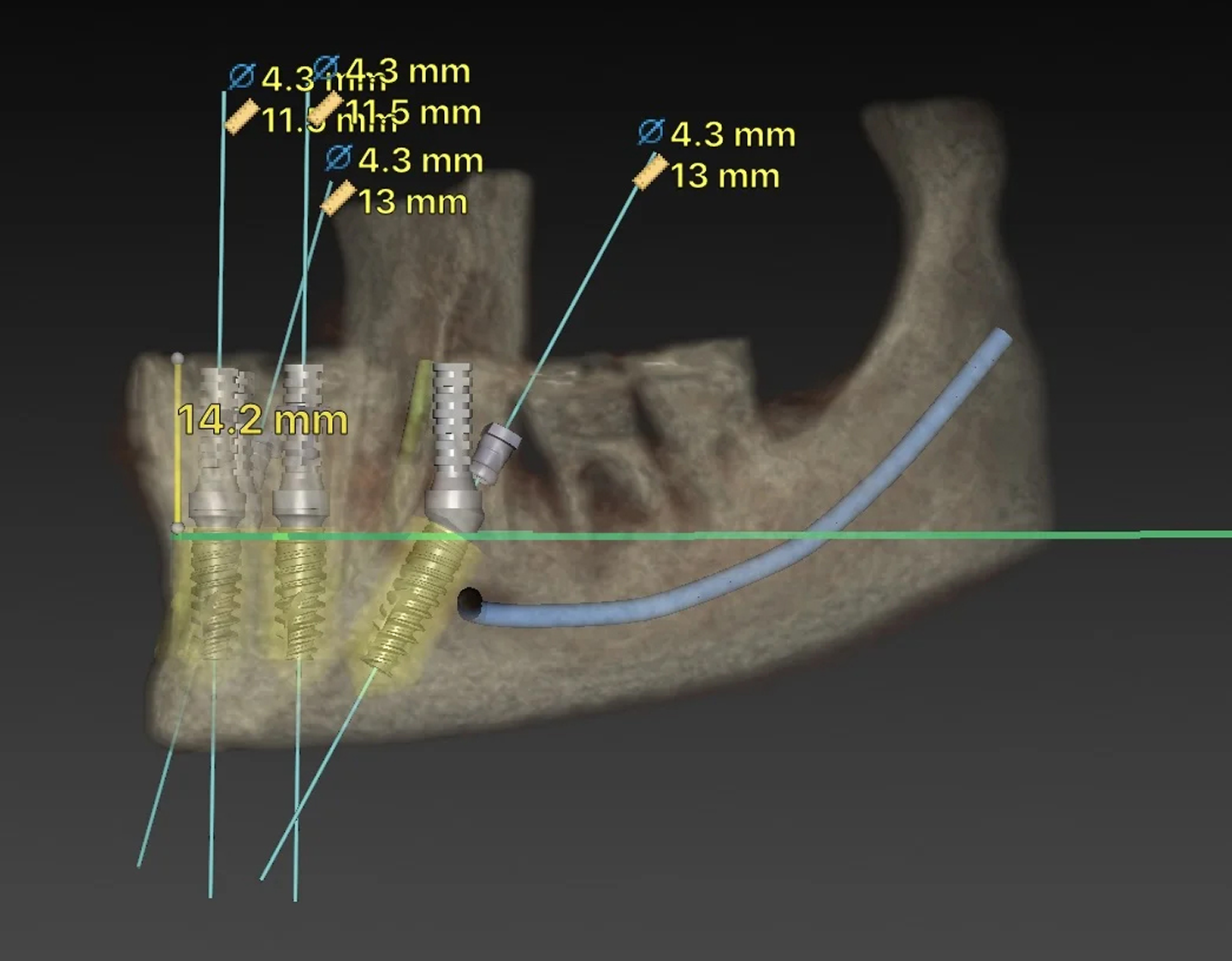 Planning of dental implants with x-ray