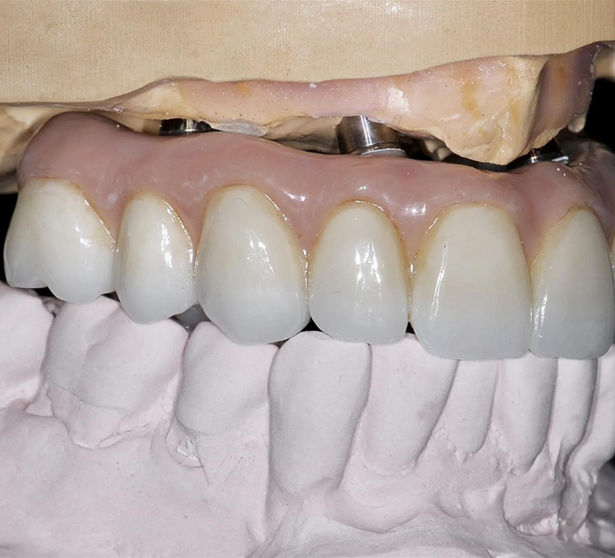 All-On-4 Dentures