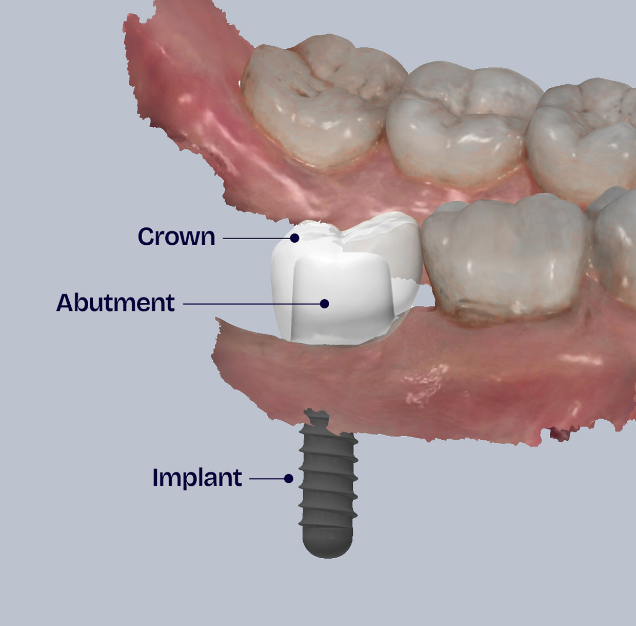 Dental Implants Further
Explained