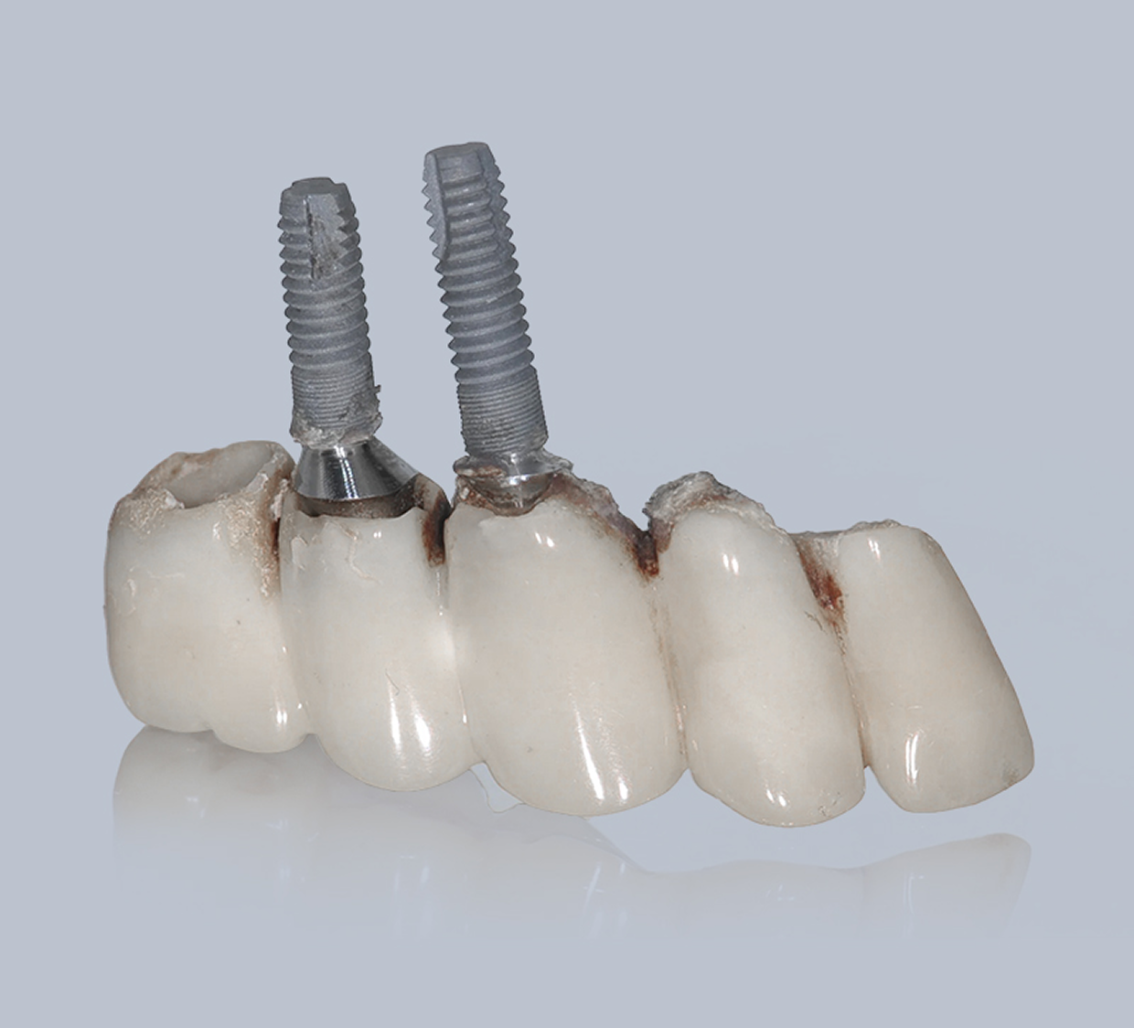 Dental Implant Failure