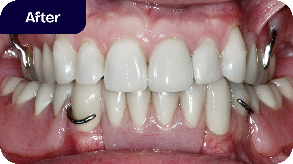 Are you a good candidate for dentures - after
