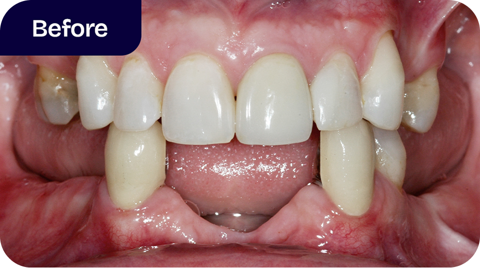 Are you a good candidate for dentures - before