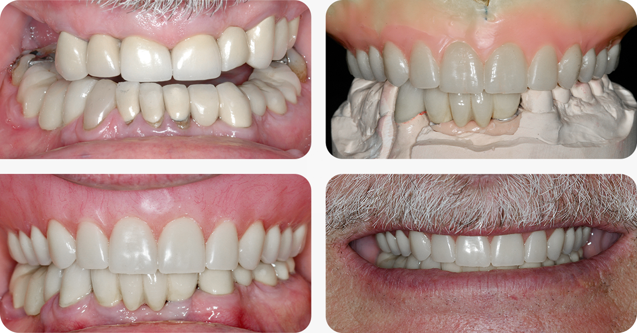 Our denture fitting and creation process - Dr. Adam Geach