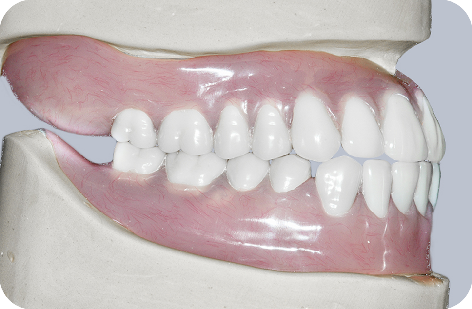 Full dentures - perfect denture option for you