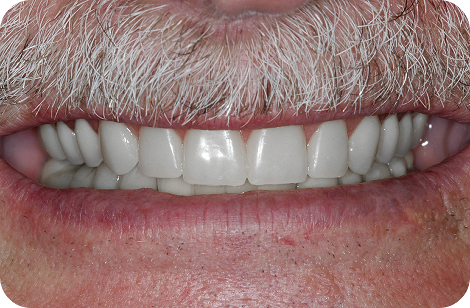 Immediate dentures - perfect denture option for you