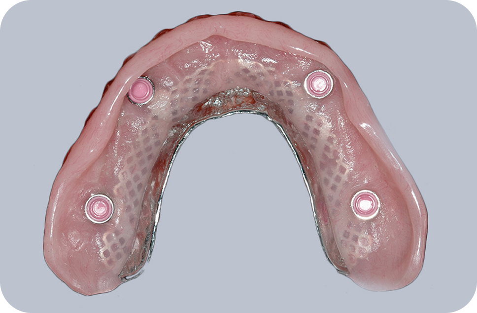 Implant-retained overdentures - perfect denture option for you
