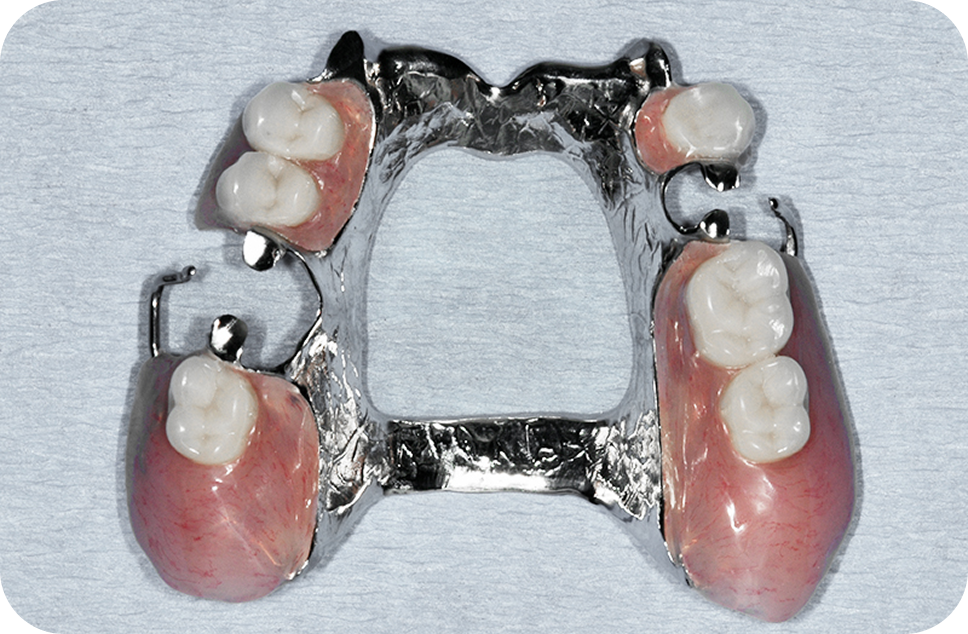 Partial dentures - perfect denture option for you