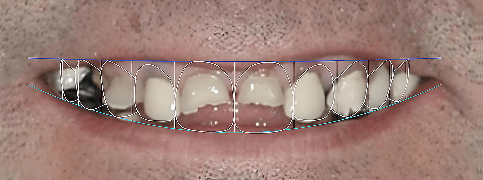 Direct bonding digital imaging
