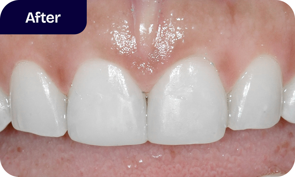 Direct bonding results - after