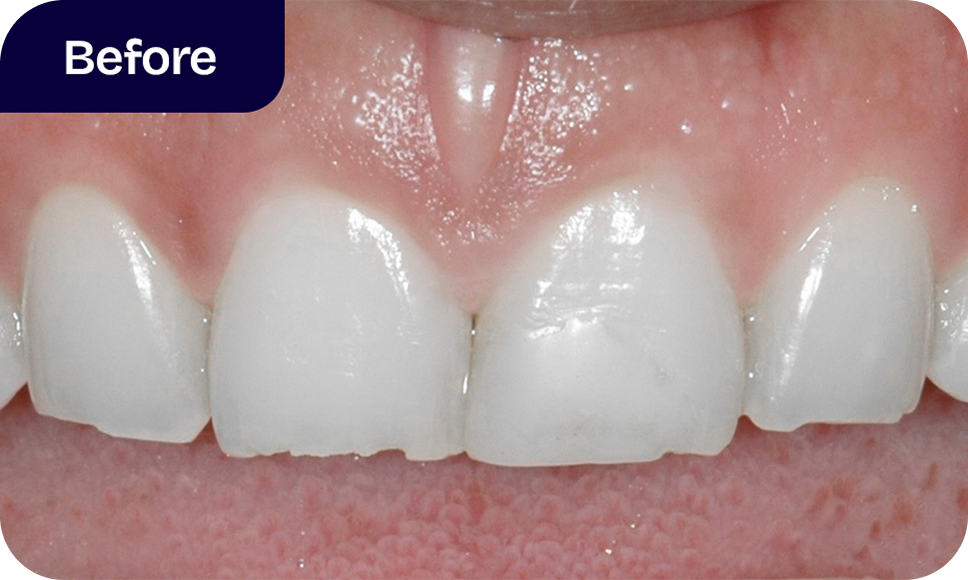 Direct bonding results - before