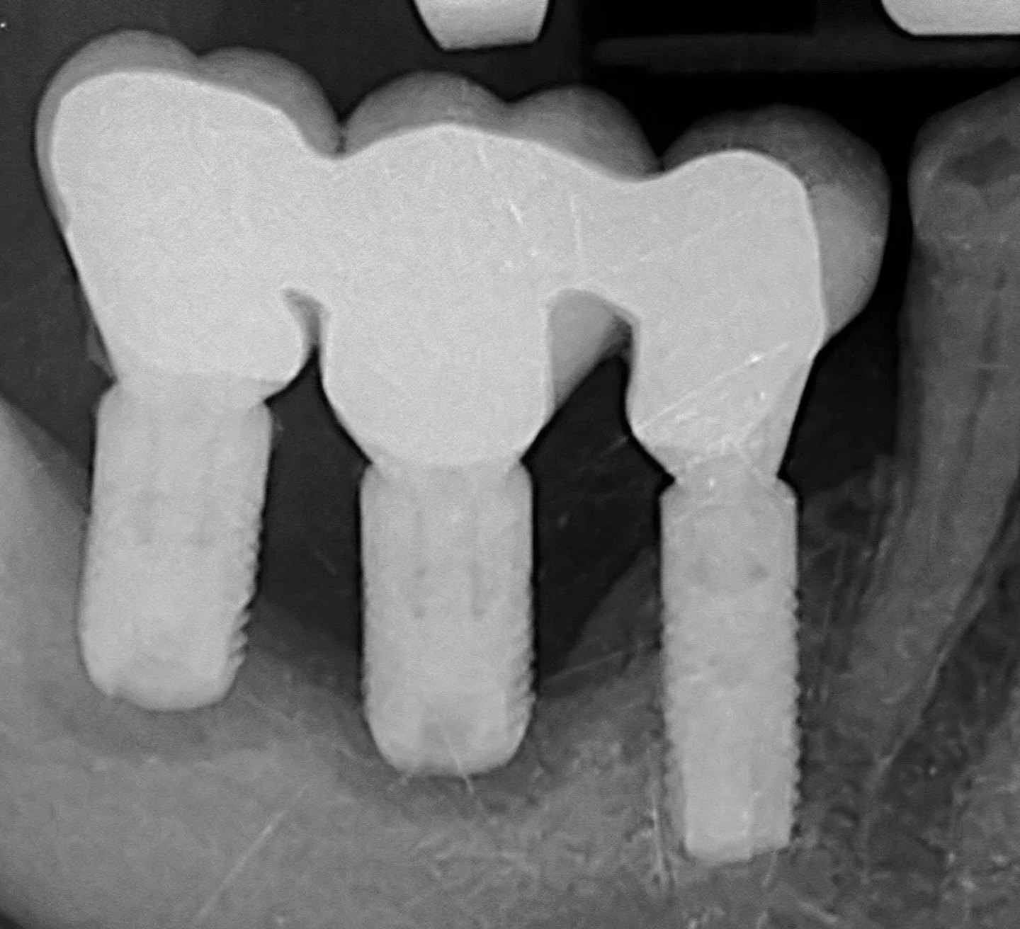Failed dental implant x-ray diagnosis