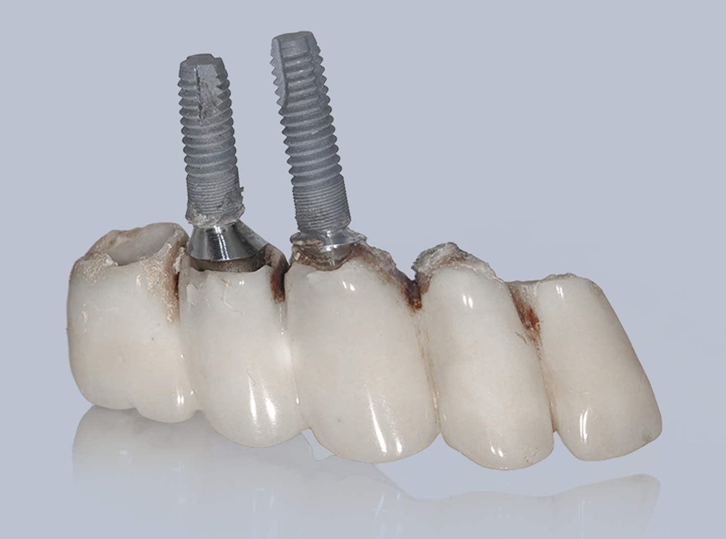 Dr. Adam Geach Dental Practitioner Specialized in Prosthodontics Failed Dental Implants