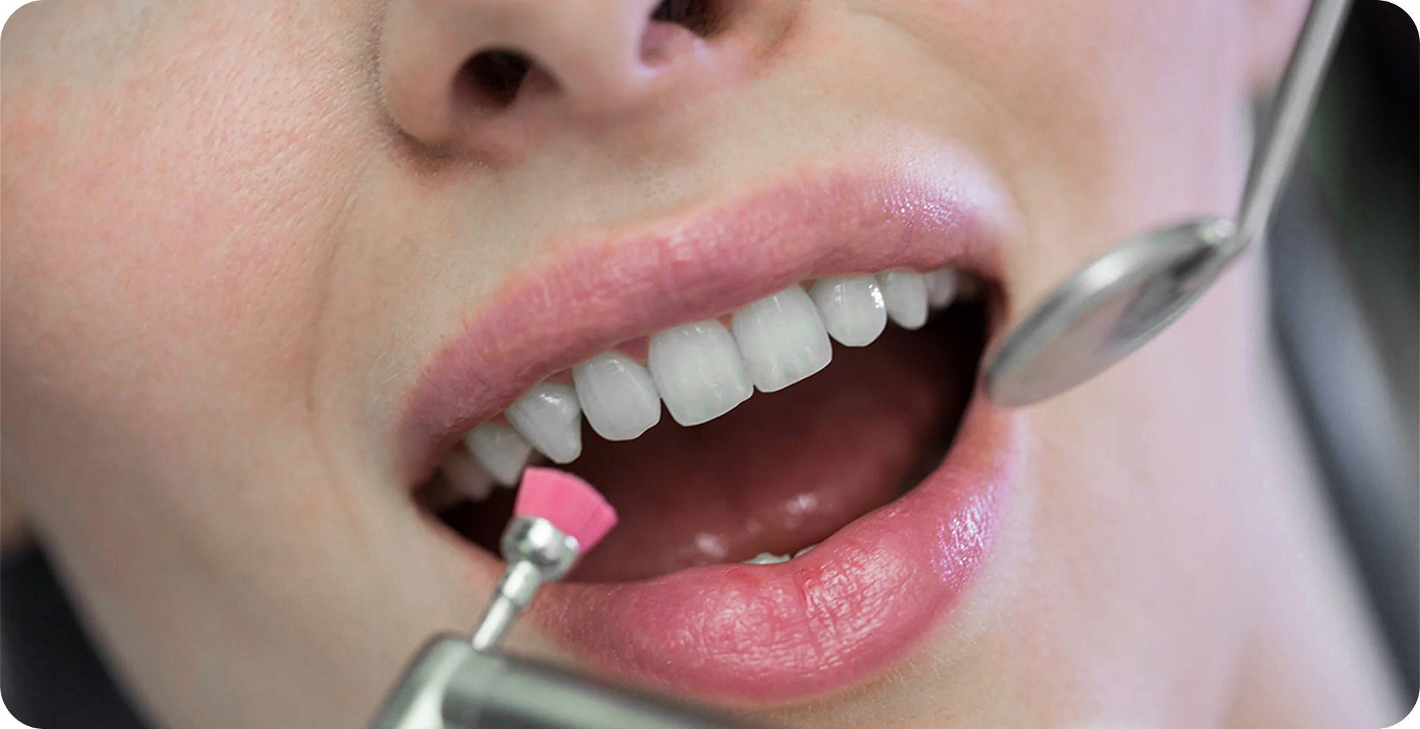 Our Fluoride Treatment Process - Dr. Adam Geach Dental Practitioner