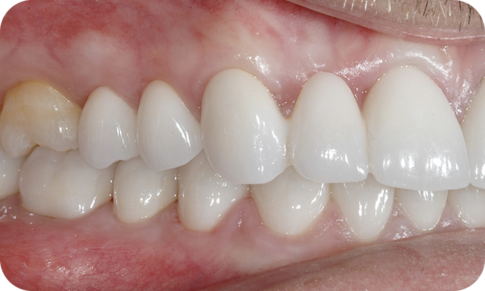 Full-Mouth Reconstruction - Dental Bridges