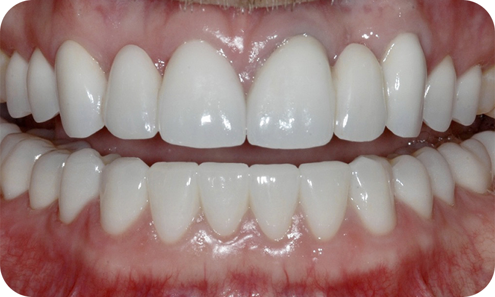 Full-Mouth Reconstruction - Dental Crowns