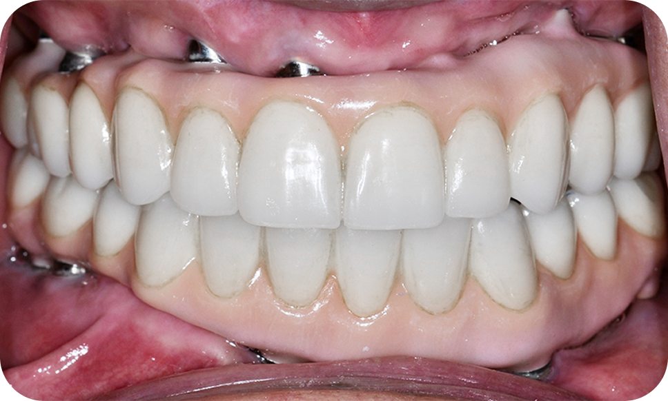 Full-Mouth Reconstruction - Dental Implants