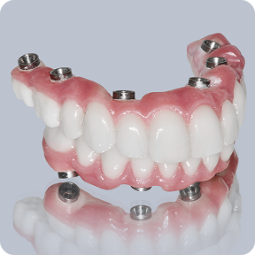 Dental Implants