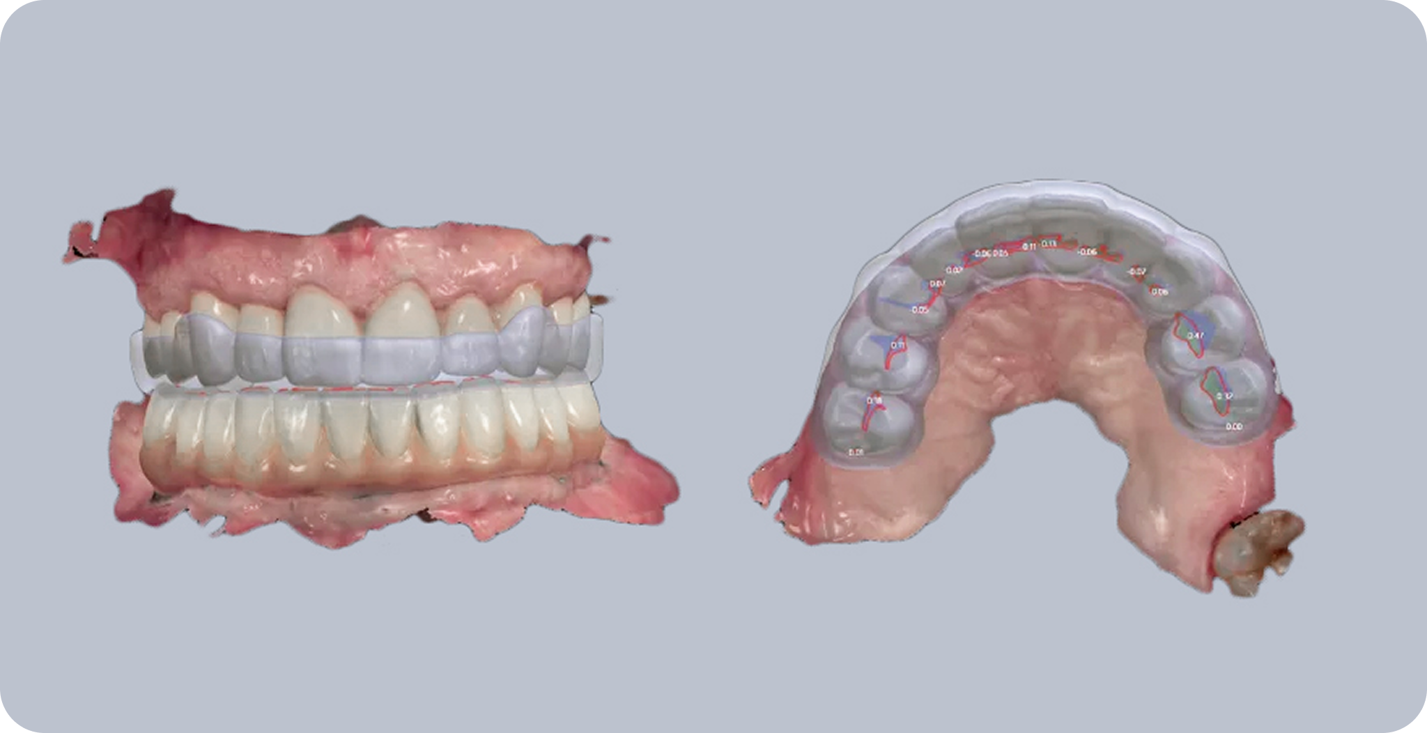 Our Nightguards for Bruxism Treatment Process - Dr. Adam Geach Dental Practitioner