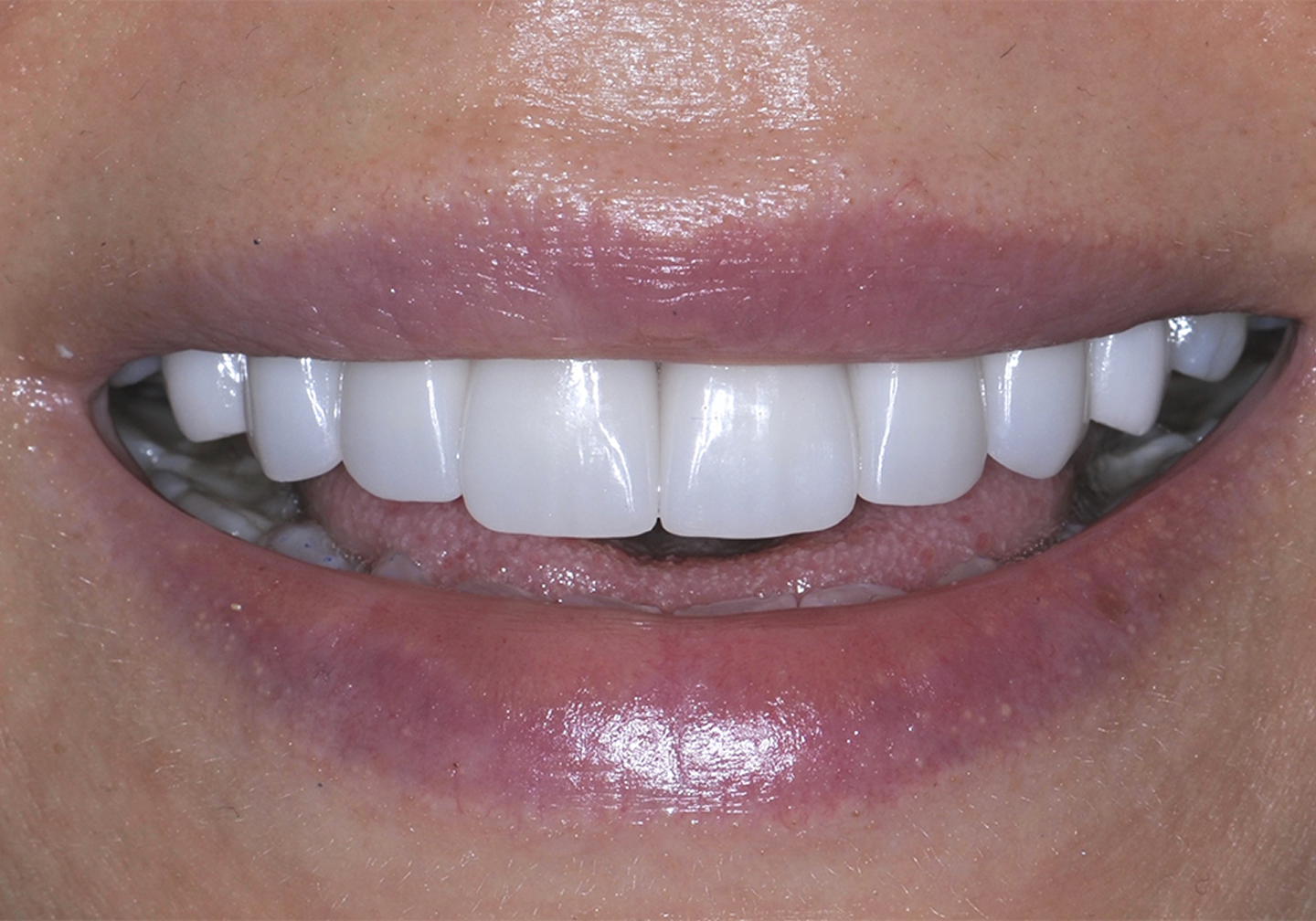 Dr. Adam Geach Dental Practitioner Specialized in Prosthodontics Porcelain Veneers