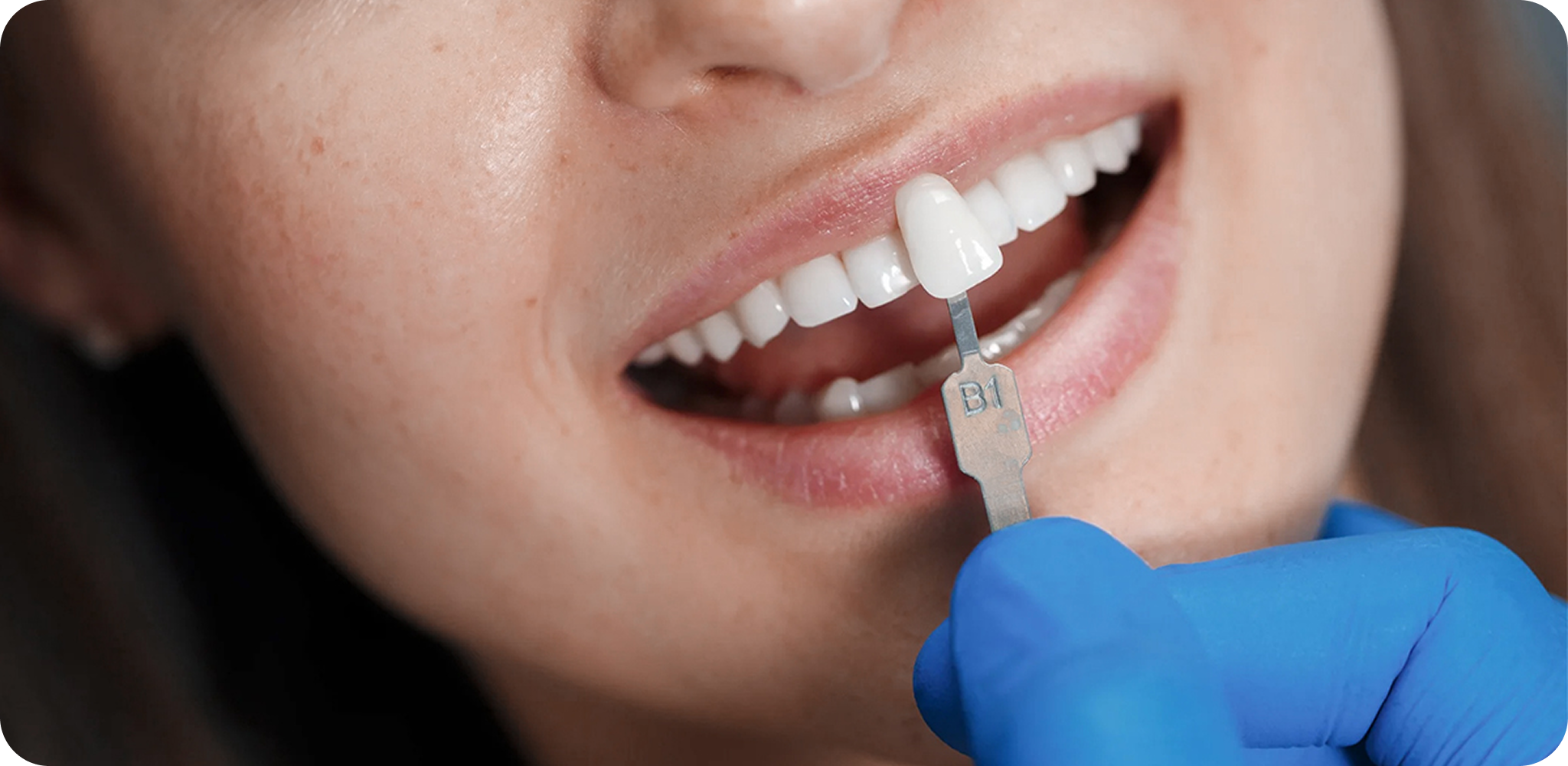 Porcelain veneers offer a multitude of benefits