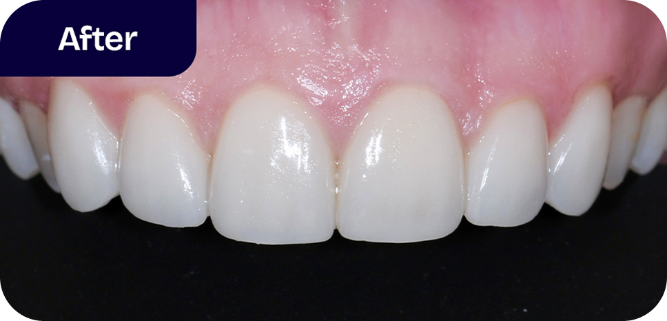 Porcelain veneers treatment process - after