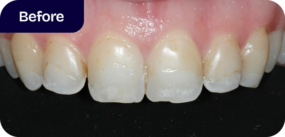Porcelain veneers treatment process - before