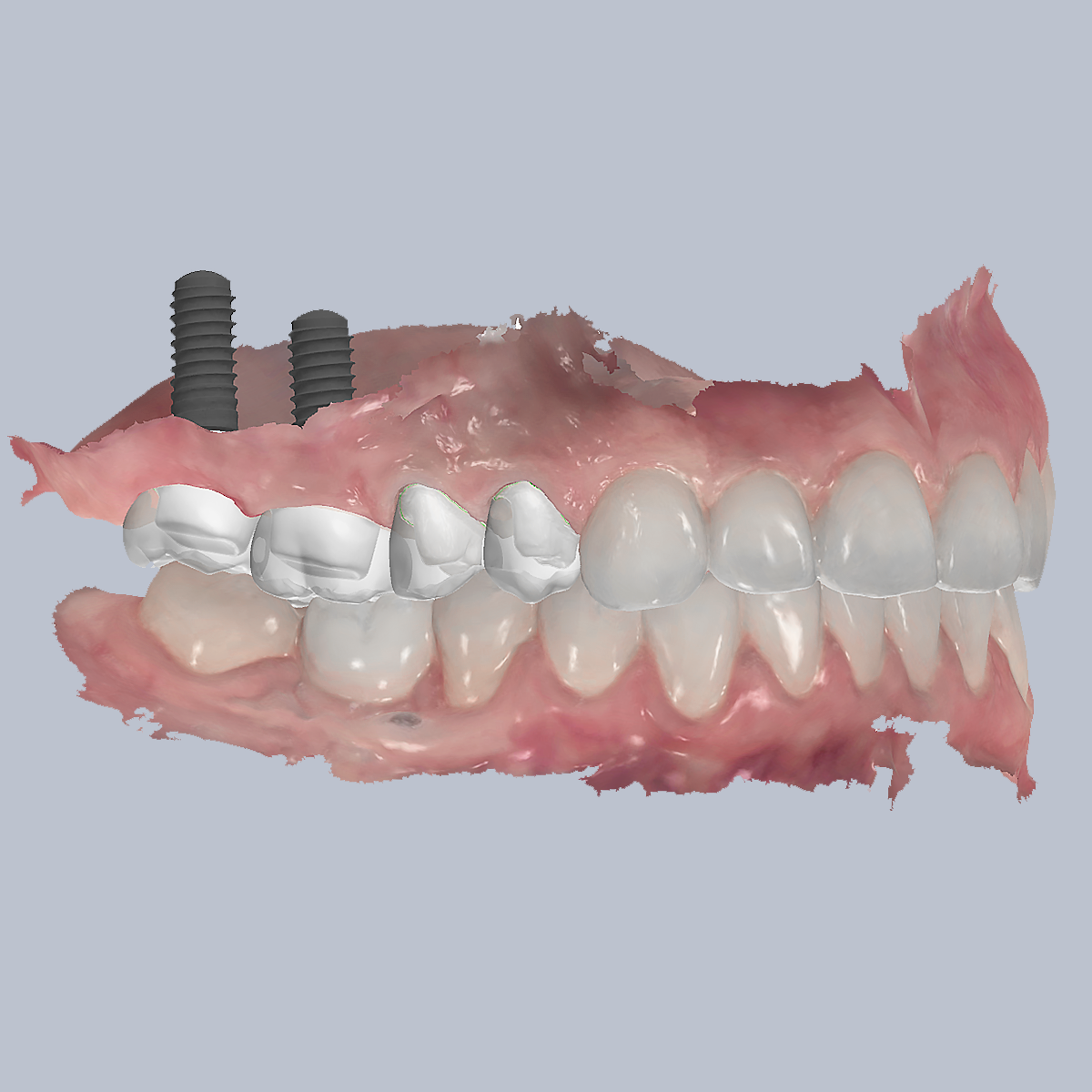 Dental Crowns