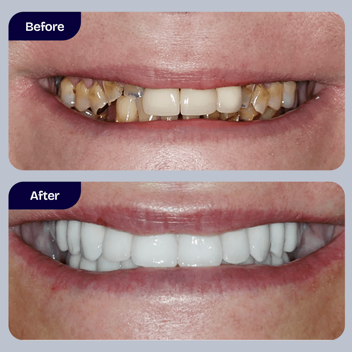Full-Mouth Reconstruction