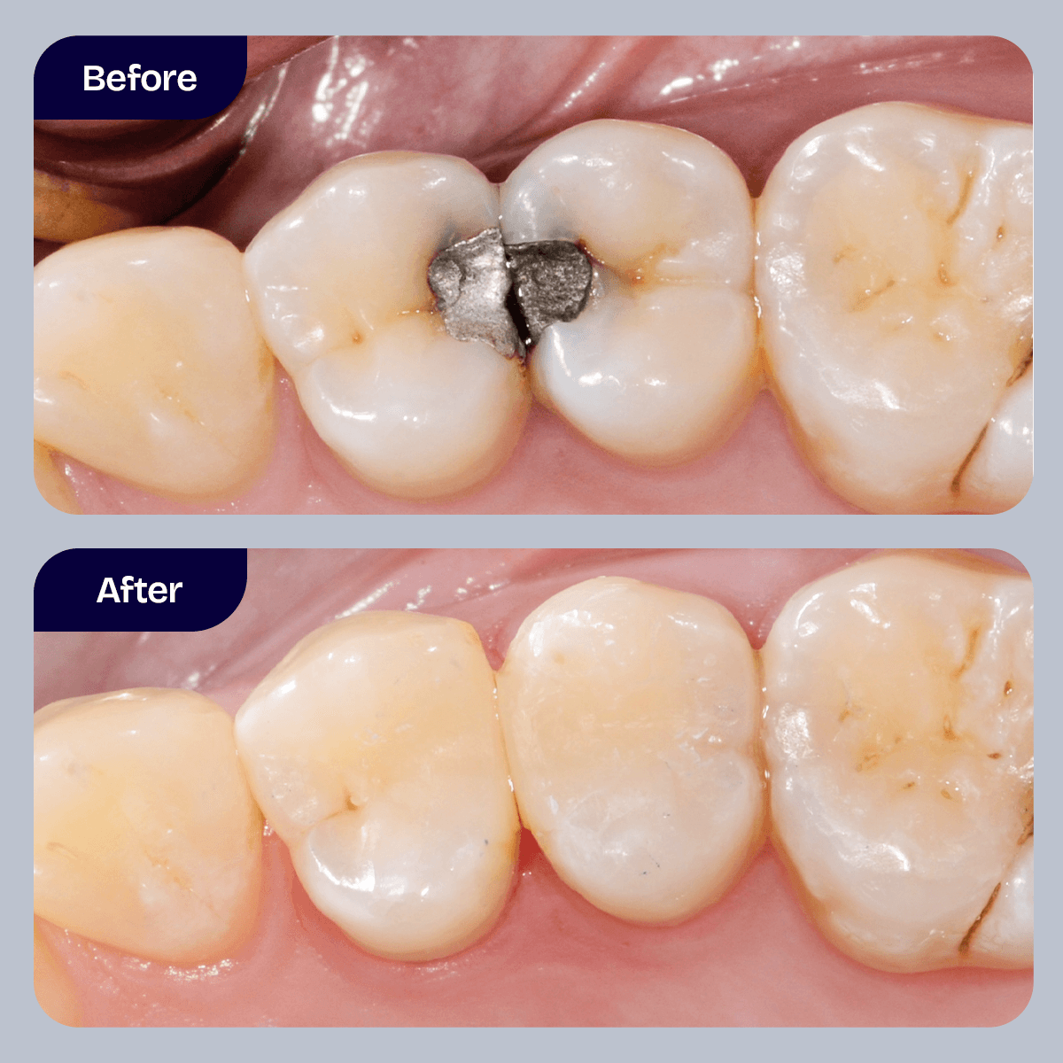 Tooth-Colored Fillings