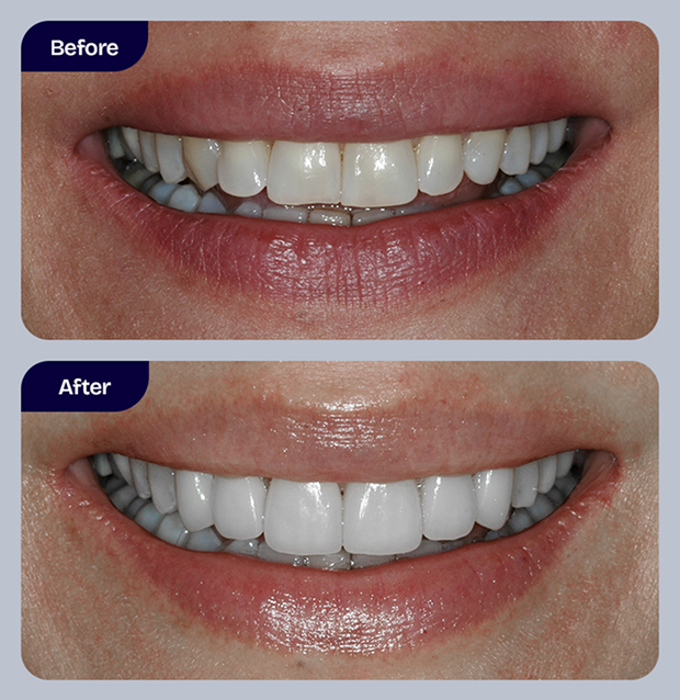 Cosmetic dentistry smile enhancement at Geach Dental
